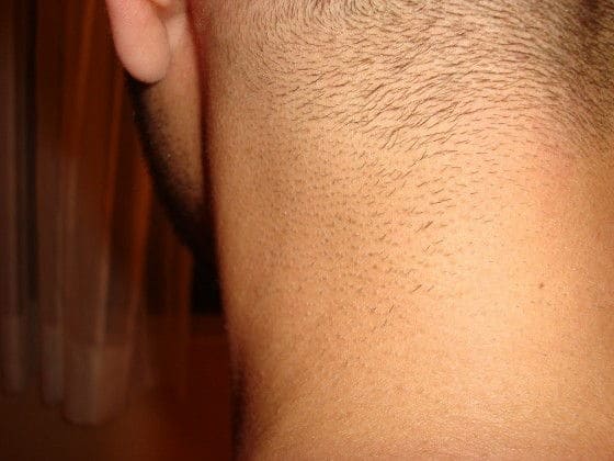 IPL Results on Neck Hair after 2 treatments