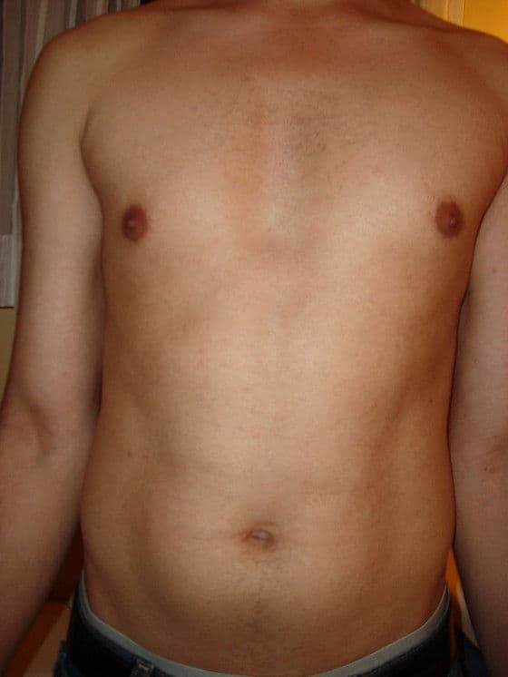 IPL Results after 2 treatments