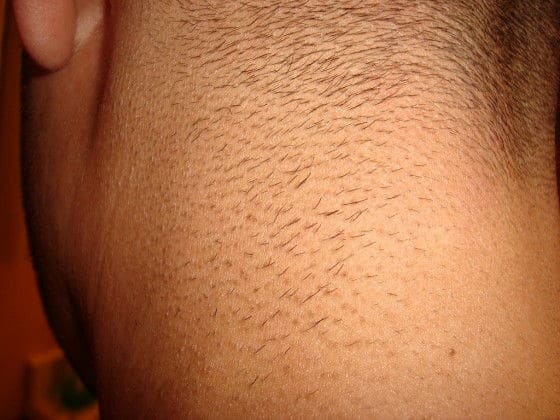 Intense Pulse Light on Mens hair
