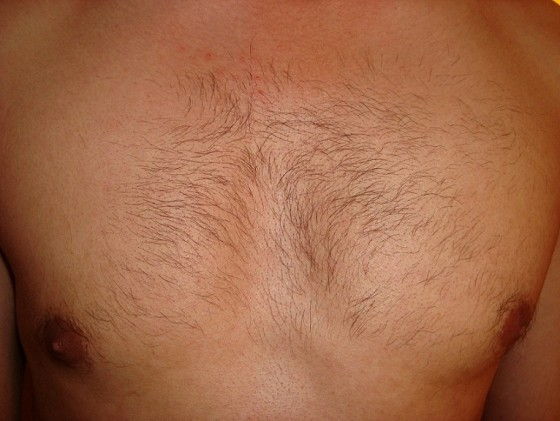 VISS IPL treatment on mens hairy chest