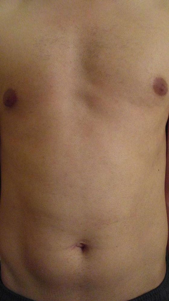 Intense Pulsed Light After 6 Treatments Intense Pulsed Light treatment on the chest and stomach