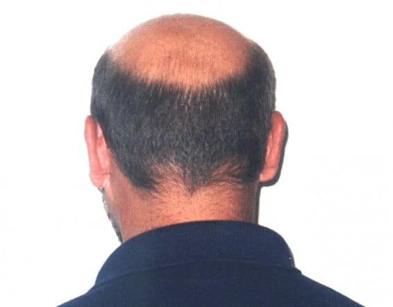 The Cure for Horseshoe Hair? It's Simple... - Unfinished Man