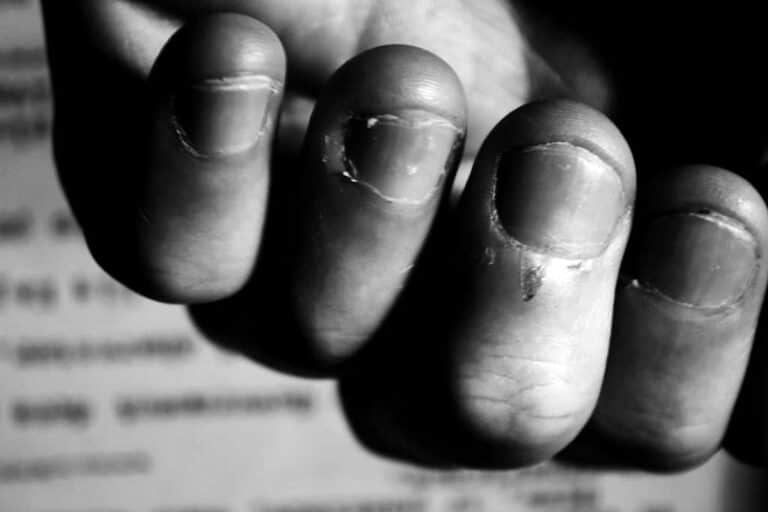 ugly ungroomed nails
