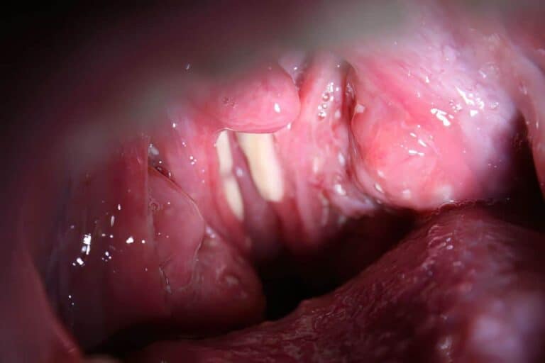 man with tonsillitis stones
