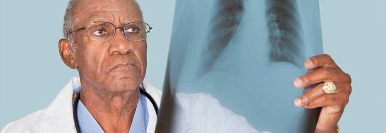 Mesothelioma X Ray