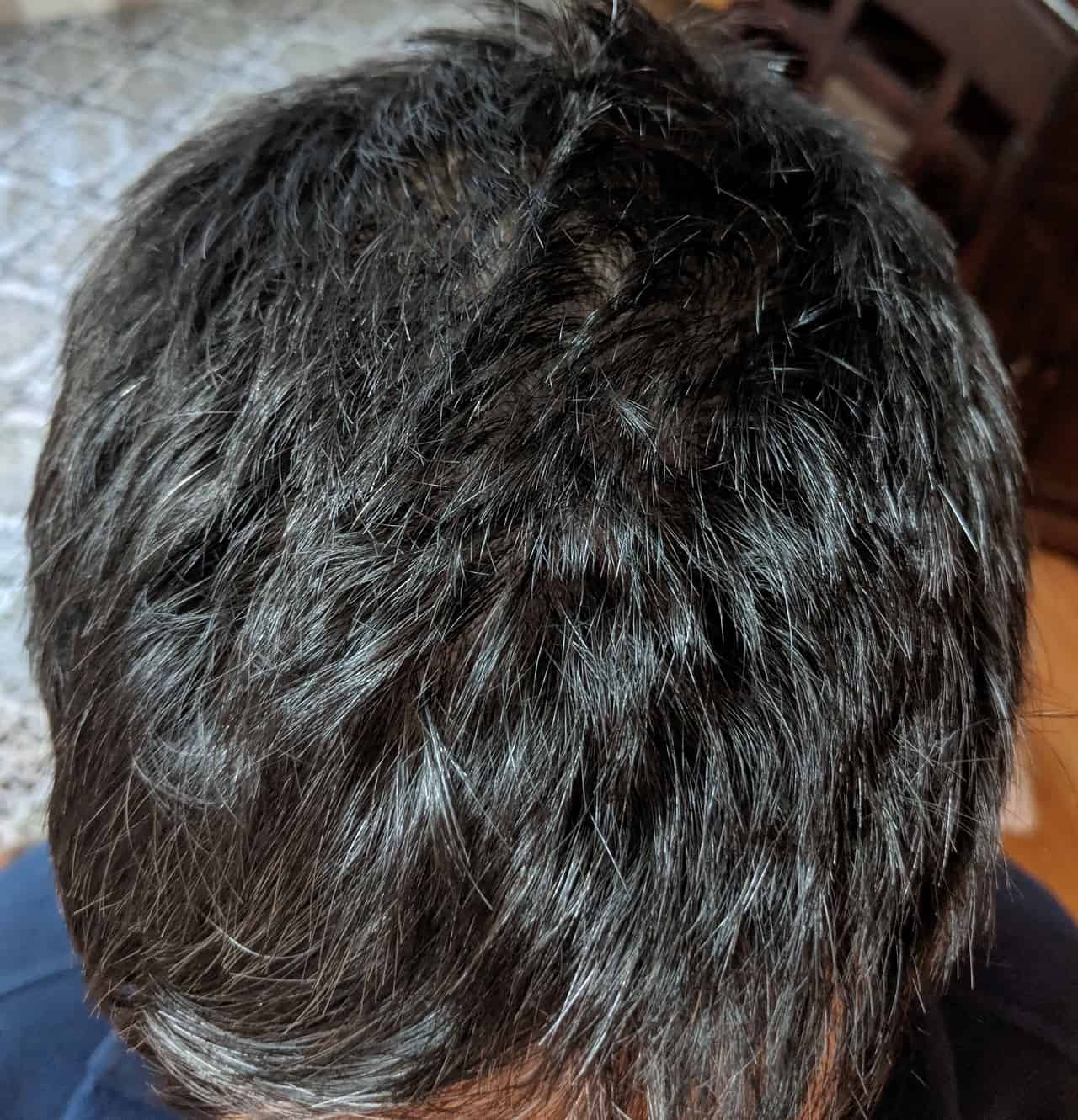 Hair Loss 2