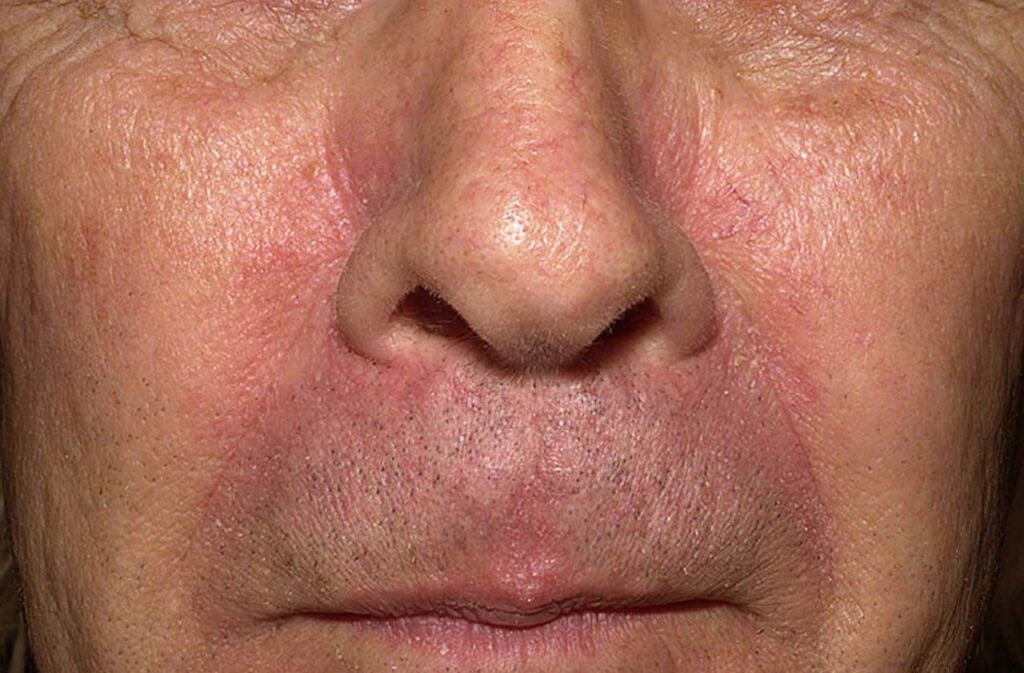 Seborrheic Dermatitis Reddit Does Their Advice Actually Work?