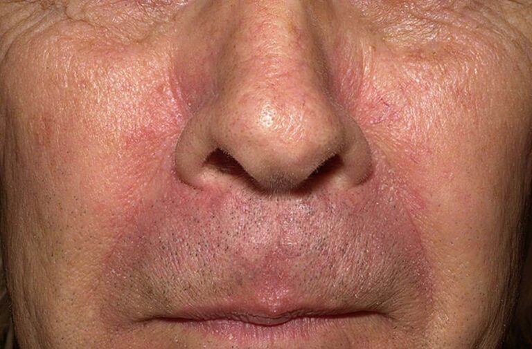 Seborrheic Dermatitis Reddit Does Their Advice Actually Work?