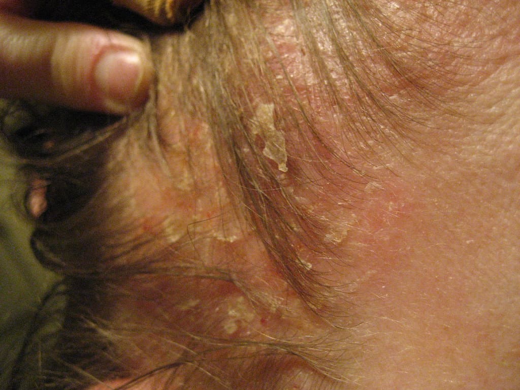 Eczema treatment baby face