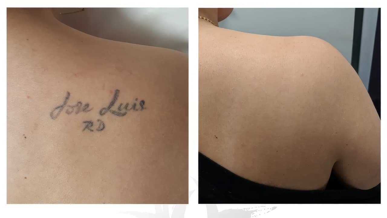 How To Deal With a Bad Tattoo: The Ultimate Guide to Erasing Your Regrettable Ink and Starting Fresh 2 bad tattoo removal before and after