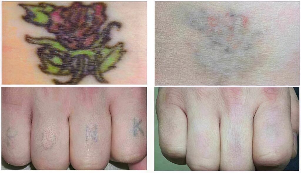 Learn the Truth About the Most Common Tattoo Removal Myths 3 bad tattoo removal from hands and body