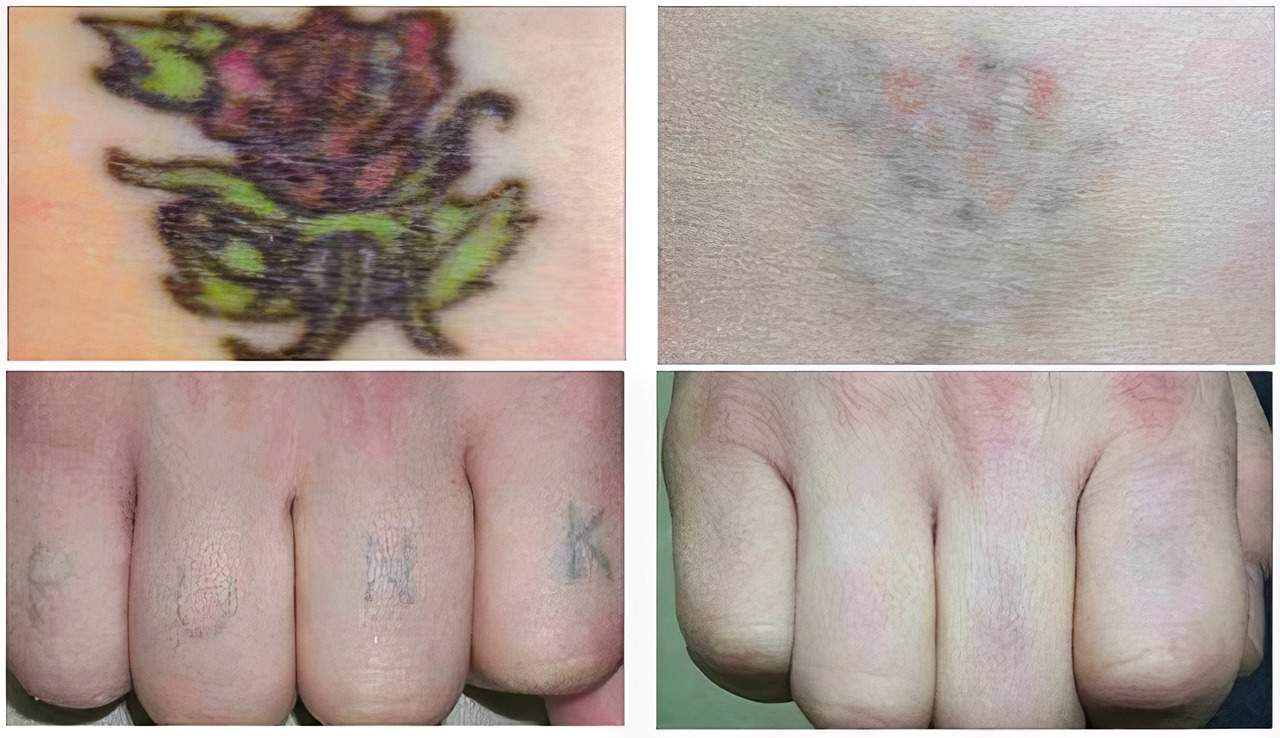 How To Deal With a Bad Tattoo: The Ultimate Guide to Erasing Your Regrettable Ink and Starting Fresh 4 bad tattoo removal from hands and body
