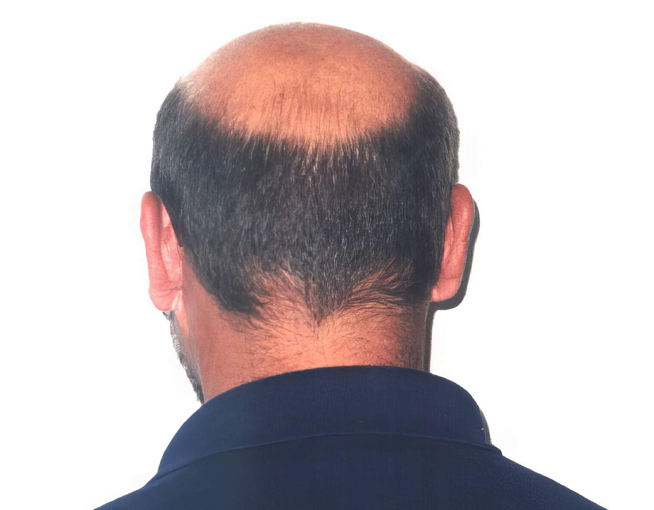 Male Pattern Baldness | Skin Cancer & Cosmetic Surgery Center of NJ
