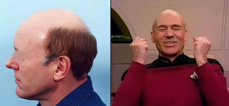 horseshoe hair men example