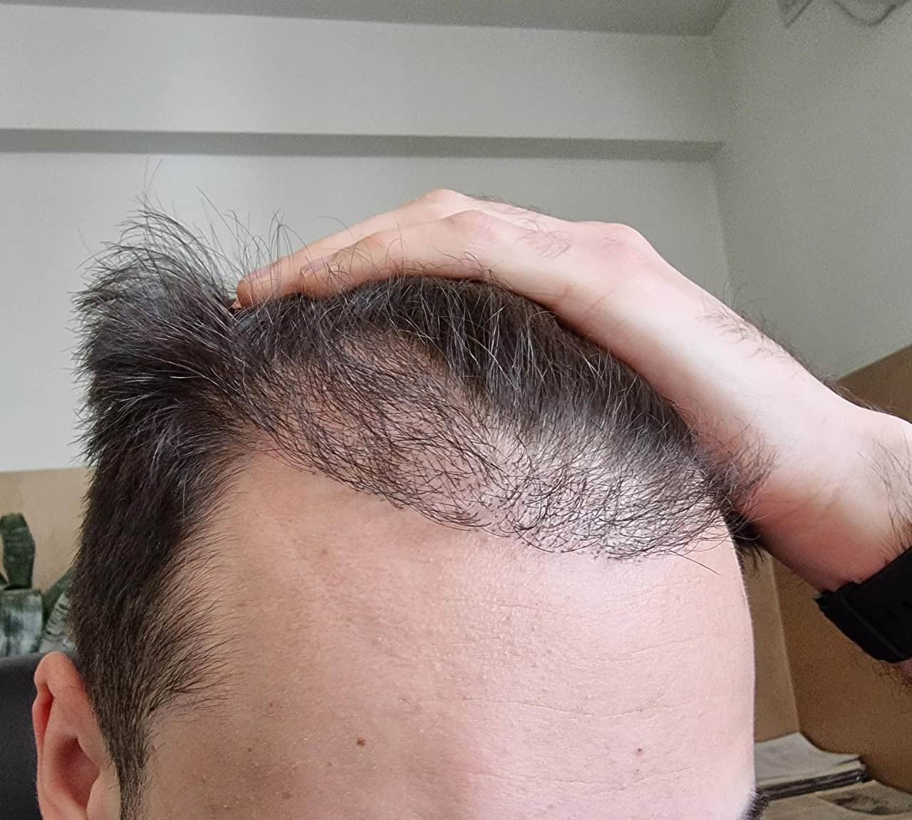 10 Best Countries For A Men's Hair Transplant: 2025 Cost & Quality Guide
