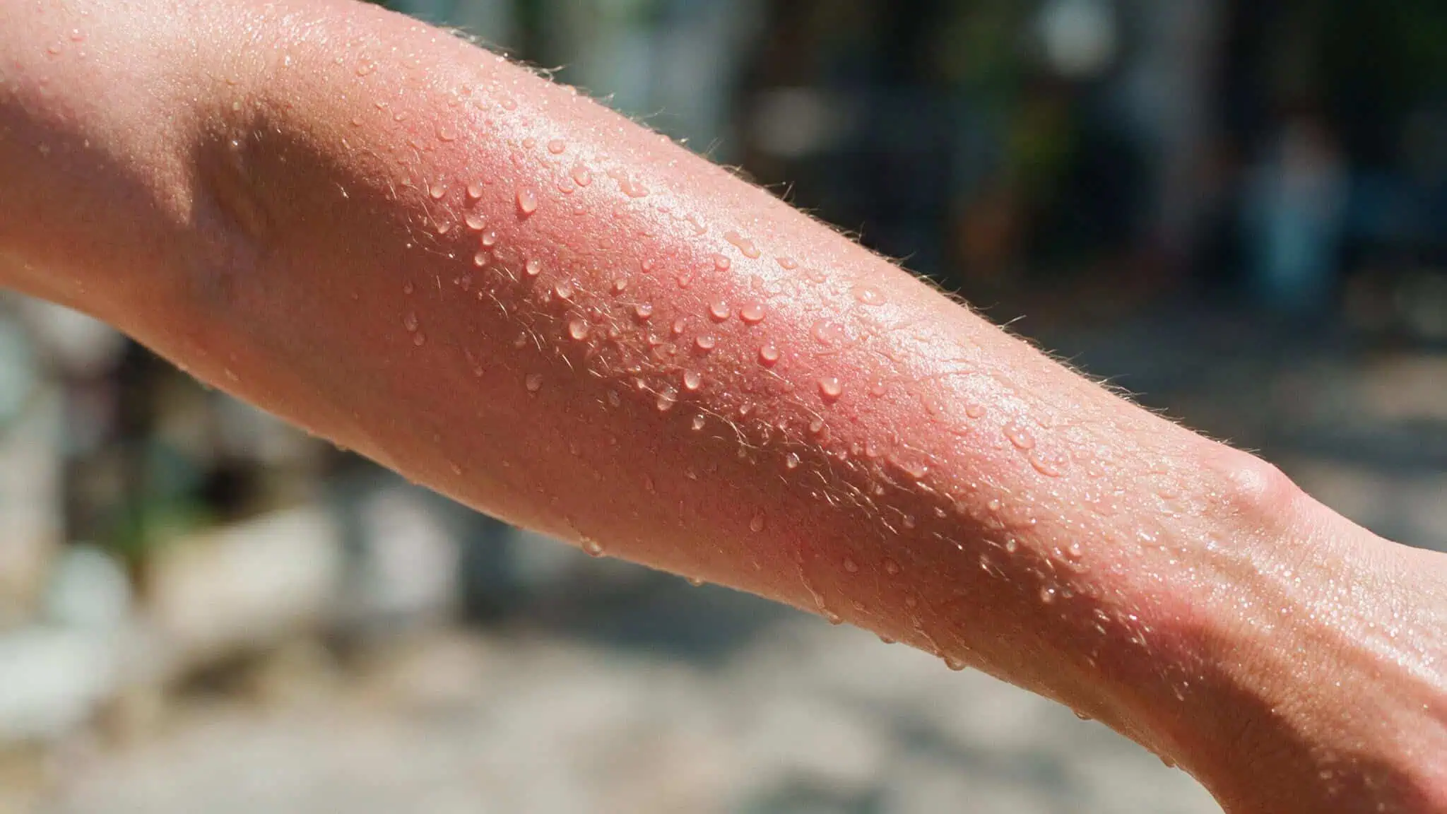 Does Sauna Help With Colds? What a 1990 RCT Reveals About Immune Conditioning 3 Close-up of a man's sweaty arm in a sauna, flushed skin, heat shock proteins and immune activation.